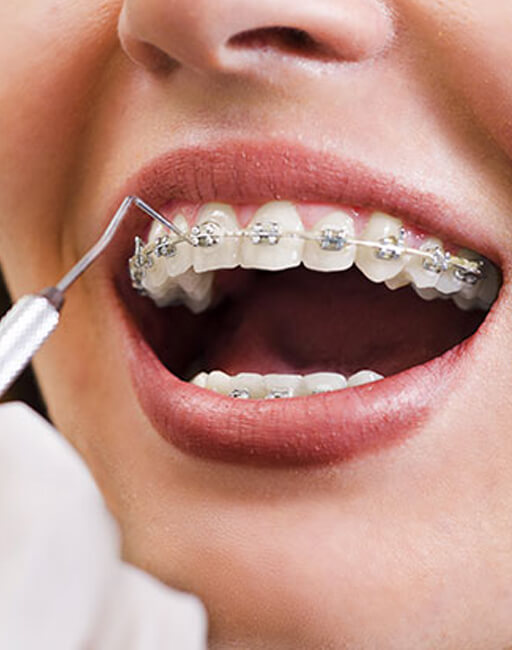 dental-braces-or-clips