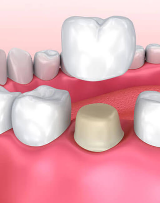 dental-crown