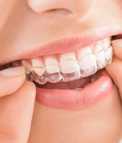 invisalign-aligners