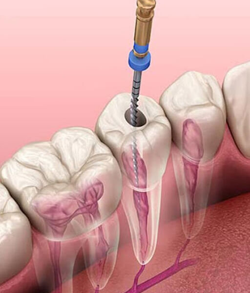 microscopic-root-canal-treatment